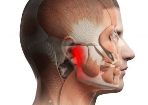 TMJ - Jaw Pain