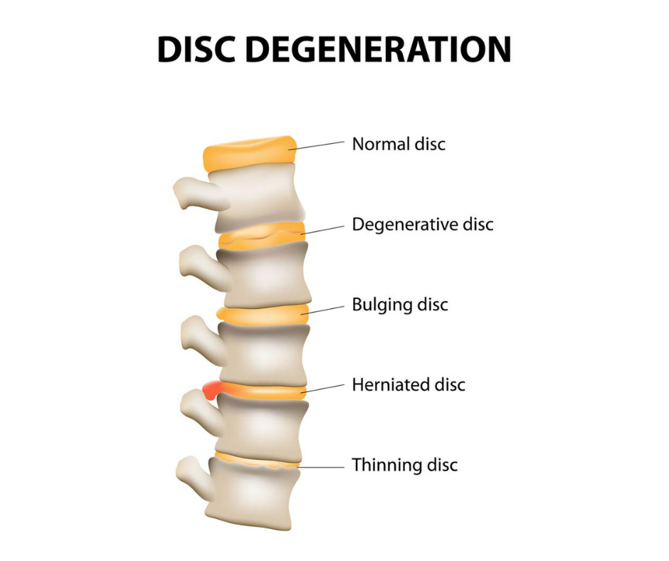 herniated disc care near me