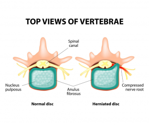 herniated-disc-treatment-near-me