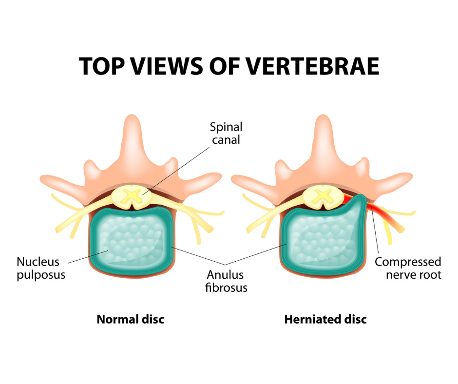 Don't Let Herniated Discs ruin your life! Chiropractic care can help! 1 herniated-disc-treatment-near-me